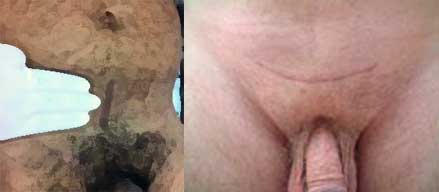 prostatectomia fig 01