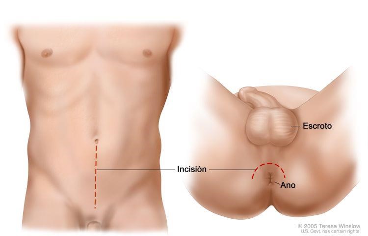 prostatectomia fig 02