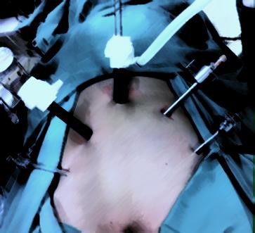 prostatectomia fig 03