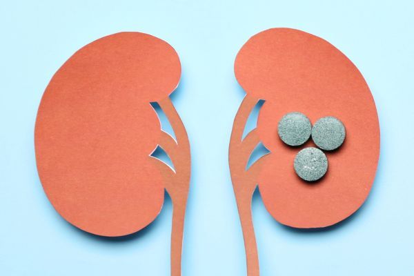 Litíase Renal