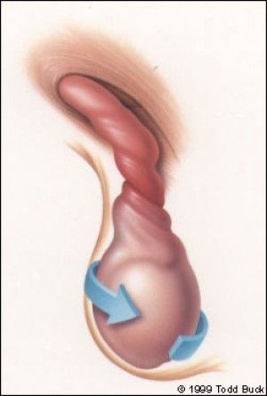 Torção testicular